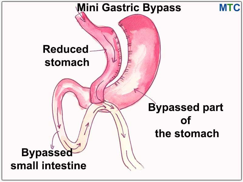 Procedure Mini Gastric Bypass
