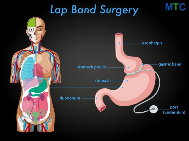 Lap band surgery anatomy