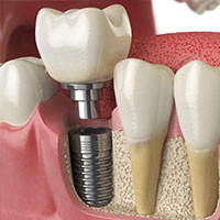 Dental Implant abroad