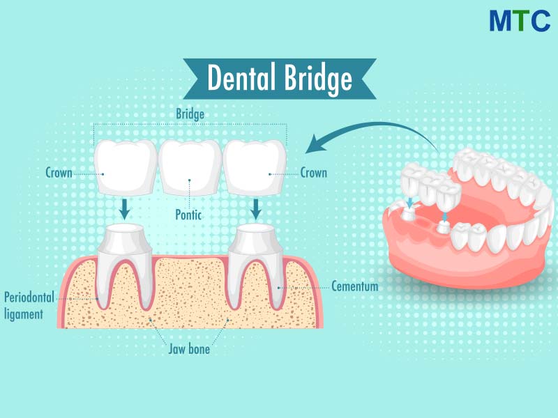 Dental bridge spanning gap between teeth