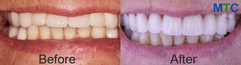 Dental veneers - Before placing 9left) & after placing (right)