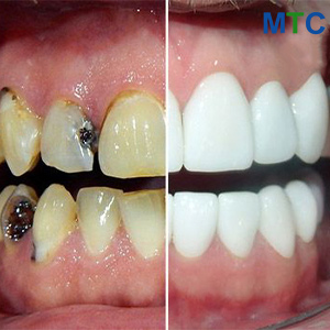 Full mouth dental implants in Casablanca, Morocco