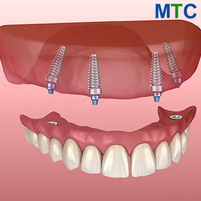 All-on-4 Dental Implants in Costa Rica