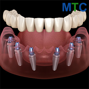 All on 6 dental implants in Guatemala City