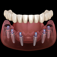 All on 6 dental implants in Casablanca, Morocco