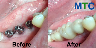 Dental Implants - Before & After