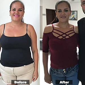 Before and After Gastric Sleeve in Puerto Vallarta