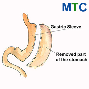 Gastric Sleeve | Type of WLS in Mexico