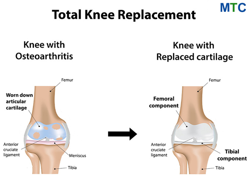 Knee condition before and after knee replacement