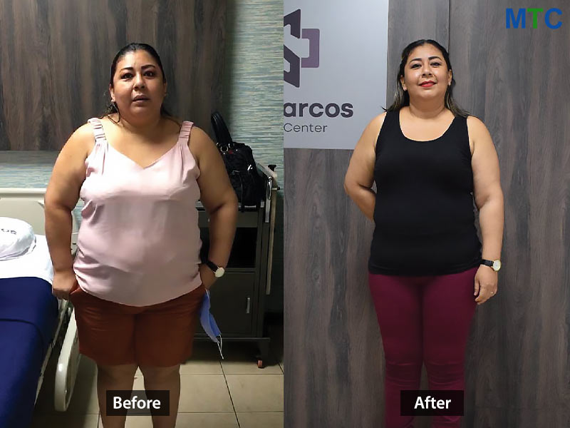 Before After Bariatric Surgery in Ecuador