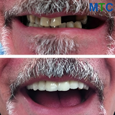 Before and After: Dental Implants Zagreb, Croatia