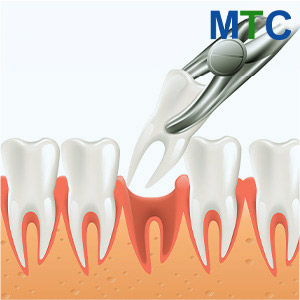 Tooth Extraction Before Dental Implants