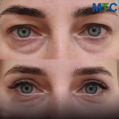 Before & After: Blepharoplasty in Turkey
