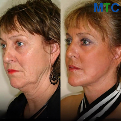Before & After: Facelift in Turkey