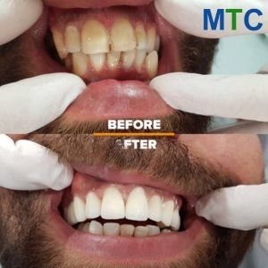 Before & After Dental Work in Split