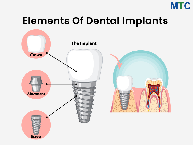 Elements of Implants