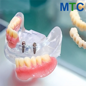 Mini dental implants in Casablanca
