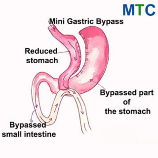 Mini gastric bypass in Turkey