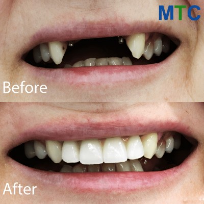 Zadar Dental Work Before & After- Dental Implants Croatia