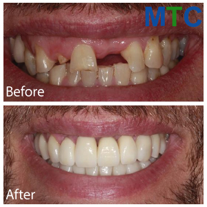 Before| After Dental Implants in Istanbul, Turkey