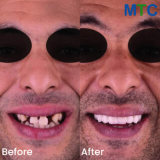 Full mouth dental implants - Before and After