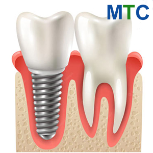 Dental Implant vs. Natural Tooth