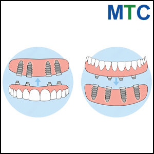 Permanent Teeth For Implants