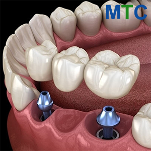 Multiple Tooth Replacement