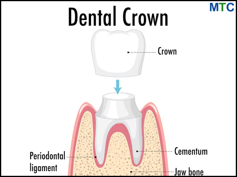 Here's a Crown Looks Like | Dental Crowns Turkey