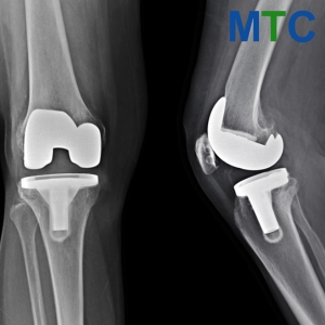 Total Knee Replacement in Istanbul