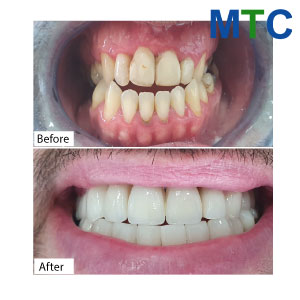 Dental Crowns in Mexico ( Before & After)