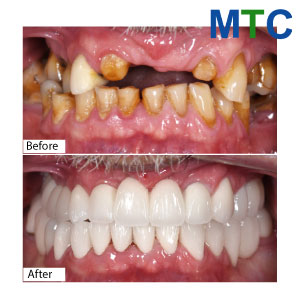 Dental Implants in Hanoi: Before & After