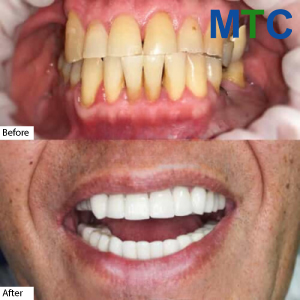 Dental venees in Los Algodones | Before & After